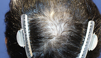 30代 男性 K.J.さん 生え際・つむじの自毛植毛（MIRAI法） 1,000株の症例（施術前）