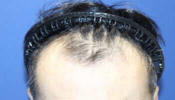 40代 男性 Y.Y.さん 生え際の自毛植毛（NC-MIRAI法） 1,200株の症例（施術前）