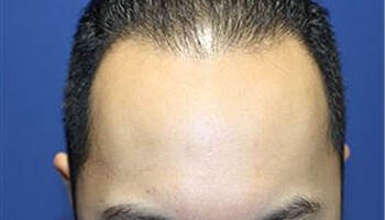 30代 男性 W.T.さん　生え際 自毛植毛（MIRAI法） 1,200株の症例（施術前）