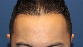 30代 男性 W.T.さん　生え際 自毛植毛（MIRAI法） 1,200株の症例（施術後）
