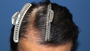 60代 男性 T.H.さん 生え際の自毛植毛（NC-MIRAI法） 1,700株の症例（施術後）