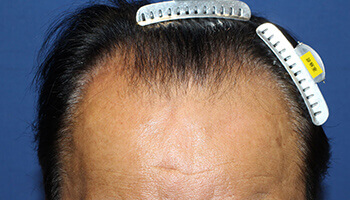 60代 男性 T.H.さん 生え際の自毛植毛（NC-MIRAI法） 1,700株の症例（施術前）
