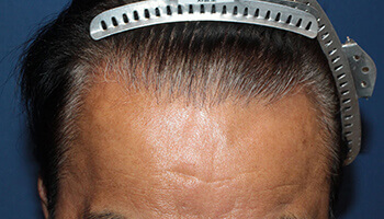 60代 男性 T.H.さん 生え際の自毛植毛（NC-MIRAI法） 1,700株の症例（施術後）