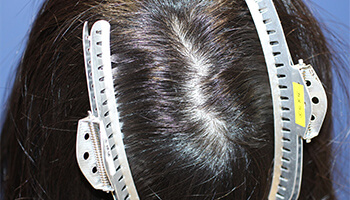 20代 女性 K.Y.さん　頭頂部 自毛植毛（MIRAI法） 400株の症例（施術前）