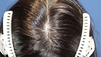 20代 女性 K.Y.さん　頭頂部 自毛植毛（MIRAI法） 400株の症例（施術後）