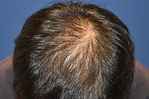 20代 男性 E.H.さん  頭頂部 自毛植毛（MIRAI法） 2,000株（施術前）