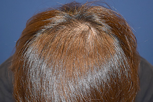 20代 男性 E.H.さん  頭頂部 自毛植毛（MIRAI法） 2,000株（施術後）