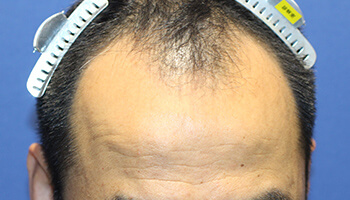 40代 男性 S.Y.さん　生え際～前頭部・頭頂部 自毛植毛（MIRAI法） 1,000株の症例（施術前）