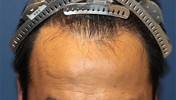 40代 男性 S.Y.さん　生え際～前頭部・頭頂部 自毛植毛（MIRAI法） 1,000株の症例（施術後）