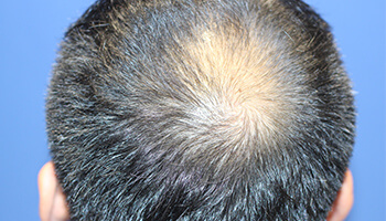 40代 男性 S.Y.さん　生え際～前頭部・頭頂部 自毛植毛（MIRAI法） 1,000株の症例（施術前）