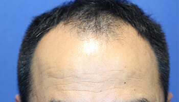 高密度自毛植毛MIRAI法の手術前の男性の生え際の写真