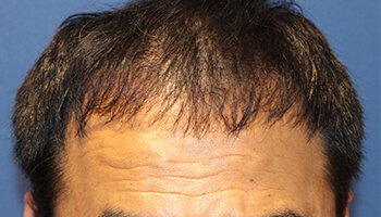 高密度自毛植毛MIRAI法の手術後の男性の生え際の写真