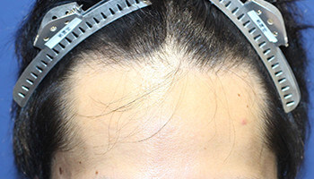 刈り上げない自毛植毛NC-MIRAI法の手術前の男性の生え際の写真