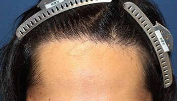 刈り上げない自毛植毛NC-MIRAI法の手術後の男性の生え際の写真