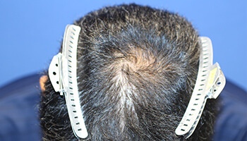 40代 男性 N.J.さん　生え際・前頭部 自毛植毛（MIRAI法） 1,400株の症例（施術前）