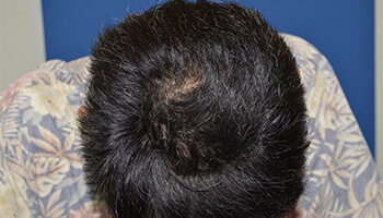 40代 男性 N.J.さん　生え際・前頭部 自毛植毛（MIRAI法） 1,400株の症例（施術後）