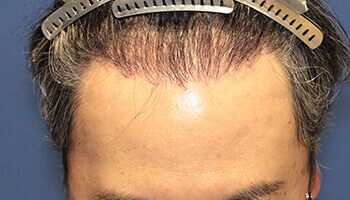 40代 男性 H.K.さん 前頭部・頭頂部の自毛植毛（MIRAI法） 3,000株の症例（施術後）