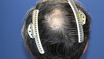 40代 男性 H.K.さん 前頭部・頭頂部の自毛植毛（MIRAI法） 3,000株の症例（施術前）