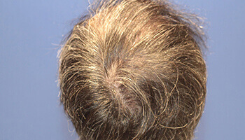 40代 男性 H.K.さん 前頭部・頭頂部の自毛植毛（MIRAI法） 3,000株の症例（施術後）