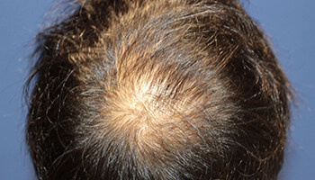 30代 男性 W.T.さん　頭頂部 自毛植毛（MIRAI法） 2,000株の症例（施術後）