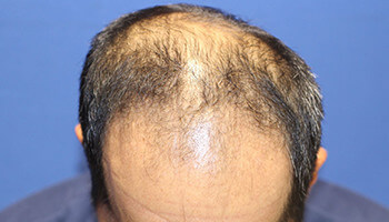 40代 男性 K.S.さん　前頭部～頭頂部 自毛植毛（MIRAI法） 2,500株の症例（施術前）