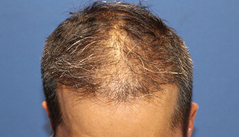 40代 男性 K.S.さん　前頭部～頭頂部 自毛植毛（MIRAI法） 2,500株の症例（施術後）