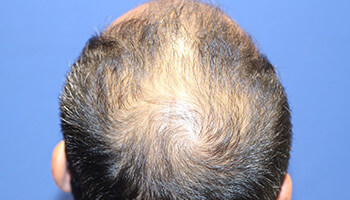 40代 男性 K.S.さん　前頭部～頭頂部 自毛植毛（MIRAI法） 2,500株の症例（施術前）