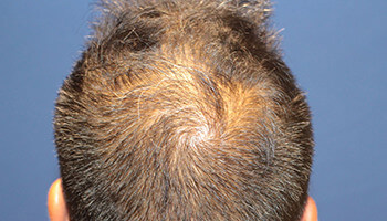 40代 男性 K.S.さん　前頭部～頭頂部 自毛植毛（MIRAI法） 2,500株の症例（施術後）