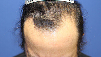 50代 男性 T.Mさん　生え際・前頭部・頭頂部 自毛植毛（MIRAI法） 3,700株の症例（施術前）