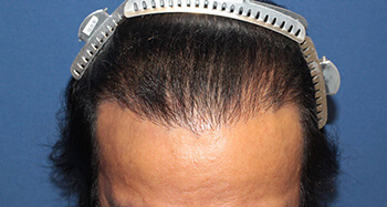 50代 男性 T.Mさん　生え際・前頭部・頭頂部 自毛植毛（MIRAI法） 3,700株の症例（施術後）