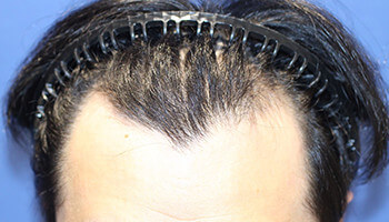 30代 男性 H.Y.さん　生え際・頭頂部 自毛植毛（NC-MIRAI法） 2,000株の症例（施術前）