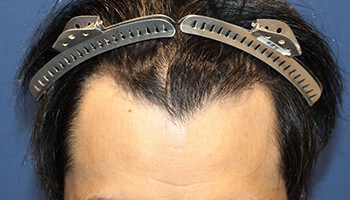 30代 男性 H.Y.さん　生え際・頭頂部 自毛植毛（NC-MIRAI法） 2,000株の症例（施術後）