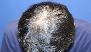 50代 男性 M.R.さん　頭頂部 自毛植毛（MIRAI法）1,500株の症例（施術前）