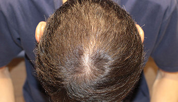 50代 男性 M.R.さん　頭頂部 自毛植毛（MIRAI法）1,500株の症例（施術後）