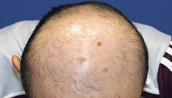 50代 男性 O.Y.さん　前頭部・頭頂部 自毛植毛（MIRAI法） 1,500株の症例（施術前）