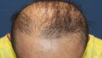 50代 男性 O.Y.さん　前頭部・頭頂部 自毛植毛（MIRAI法） 1,500株の症例（施術後）