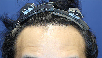 	30代 男性 I.H.さん　生え際・頭頂部 自毛植毛（MIRAI法） 1,200株の症例（施術前）