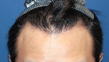 	30代 男性 I.H.さん　生え際・頭頂部 自毛植毛（MIRAI法） 1,200株の症例（施術後）
