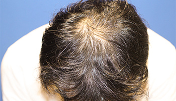 	30代 男性 I.H.さん　生え際・頭頂部 自毛植毛（MIRAI法） 1,200株の症例（施術前）
