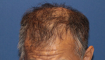 60代 男性 K.K.さん　前頭部～頭頂部 自毛植毛（MIRAI法） 3,000株の症例（施術後）
