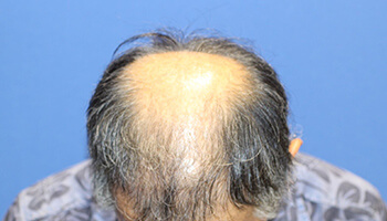 60代 男性 K.K.さん　前頭部～頭頂部 自毛植毛（MIRAI法） 3,000株の症例（施術前）