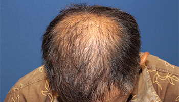 60代 男性 K.K.さん　前頭部～頭頂部 自毛植毛（MIRAI法） 3,000株の症例（施術後）