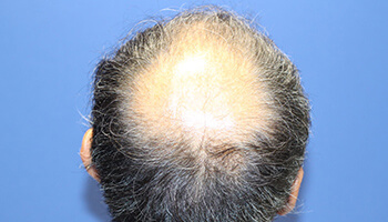 60代 男性 K.K.さん　前頭部～頭頂部 自毛植毛（MIRAI法） 3,000株の症例（施術前）