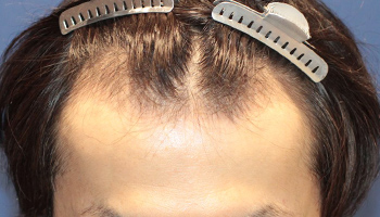 30代 男性 S.T.さん  生え際 自毛植毛（MIRAI法） 1,500株の症例（施術前）