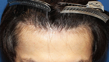 30代 男性 S.T.さん  生え際 自毛植毛（MIRAI法） 1,500株の症例（施術後）