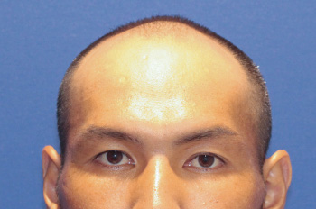 	30代 男性 S.M.さん 生え際・前頭部・頭頂部 自毛植毛（MIRAI法） 2,400株の症例（施術前）