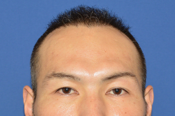 	30代 男性 S.M.さん 生え際・前頭部・頭頂部 自毛植毛（MIRAI法） 2,400株の症例（施術後）
