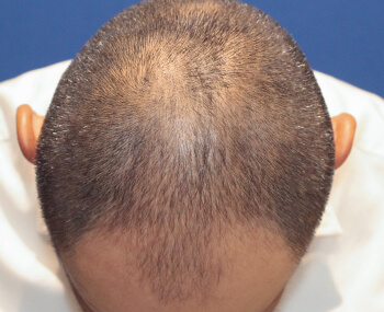 	30代 男性 S.M.さん 生え際・前頭部・頭頂部 自毛植毛（MIRAI法） 2,400株の症例（施術前）