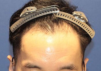 20代 男性 N.K.さん  生え際・前頭部 自毛植毛（MIRAI法） 1,500株の症例（施術前）
