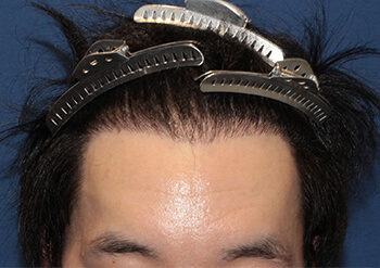 20代 男性 N.K.さん  生え際・前頭部 自毛植毛（MIRAI法） 1,500株の症例（施術後）
